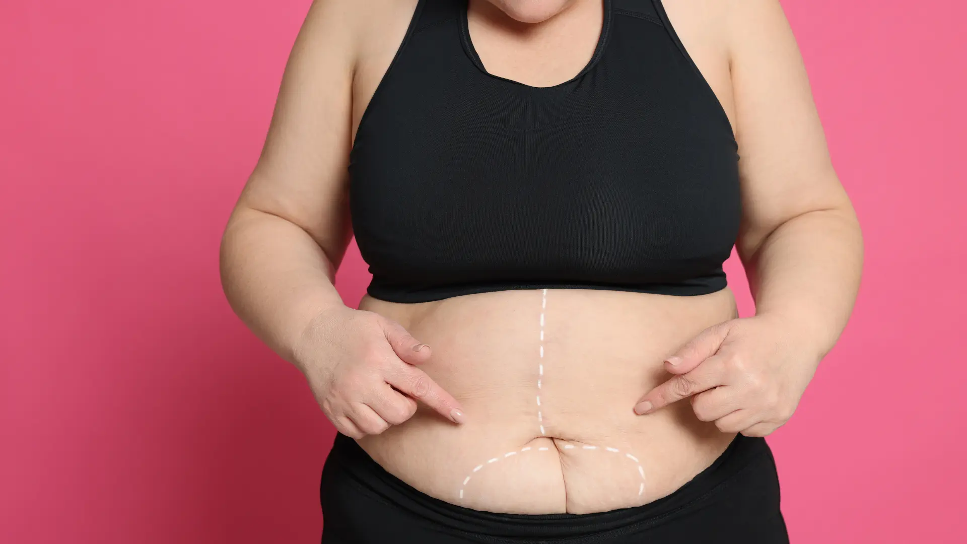 Cirurgia Bariátrica
