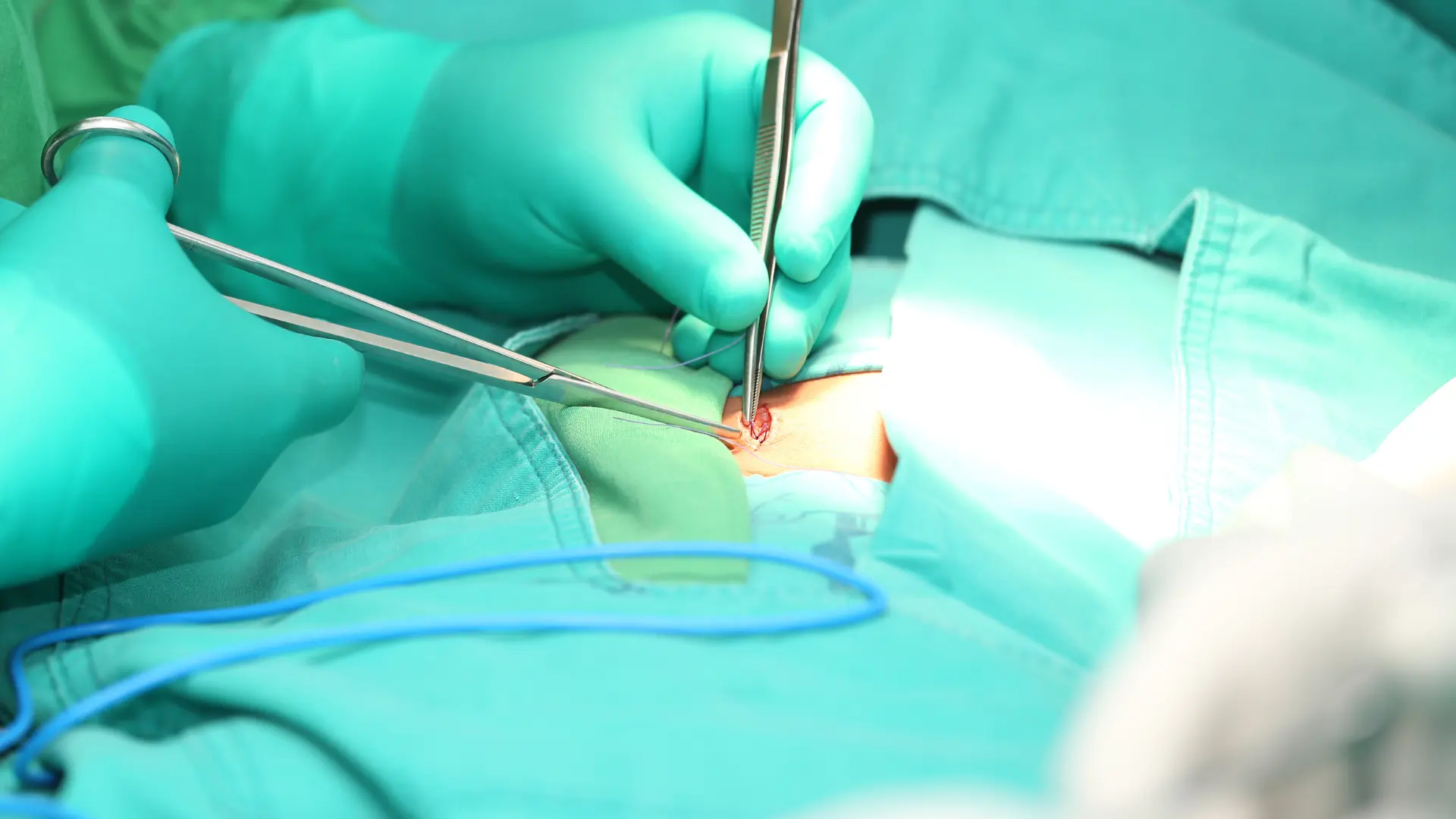 Cirurgia de Hérnia Abdominal